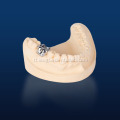 Customized metal dental crown